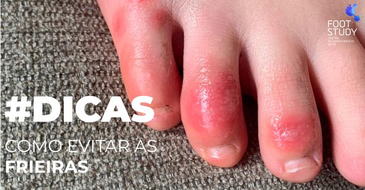 Saiba como evitar as Frieiras